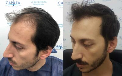 Top 3 Casos de Éxito de Capilea: