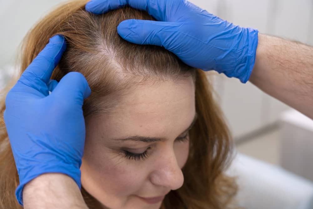 mujer con pérdida de cabello