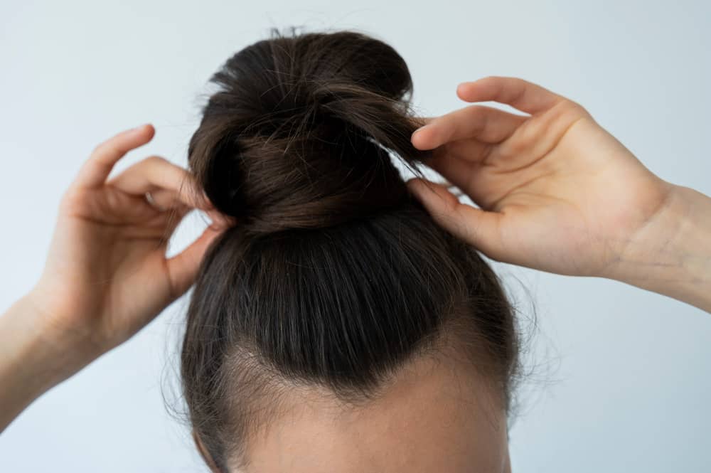 Alopecia por tracción